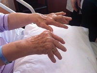 Romatoid Artrit Hamilelik Belirtileri ve Tedavisi