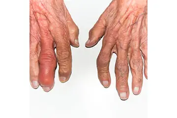 Artrit Romatoid Belirtileri ve Tedavisi