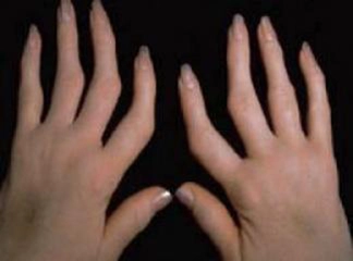 Seronegatif Artrit Belirtileri ve Tedavisi