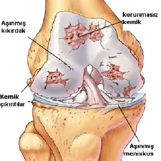 Dejeneratif Artrit