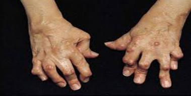 Seropozitif Romatoid Artrit